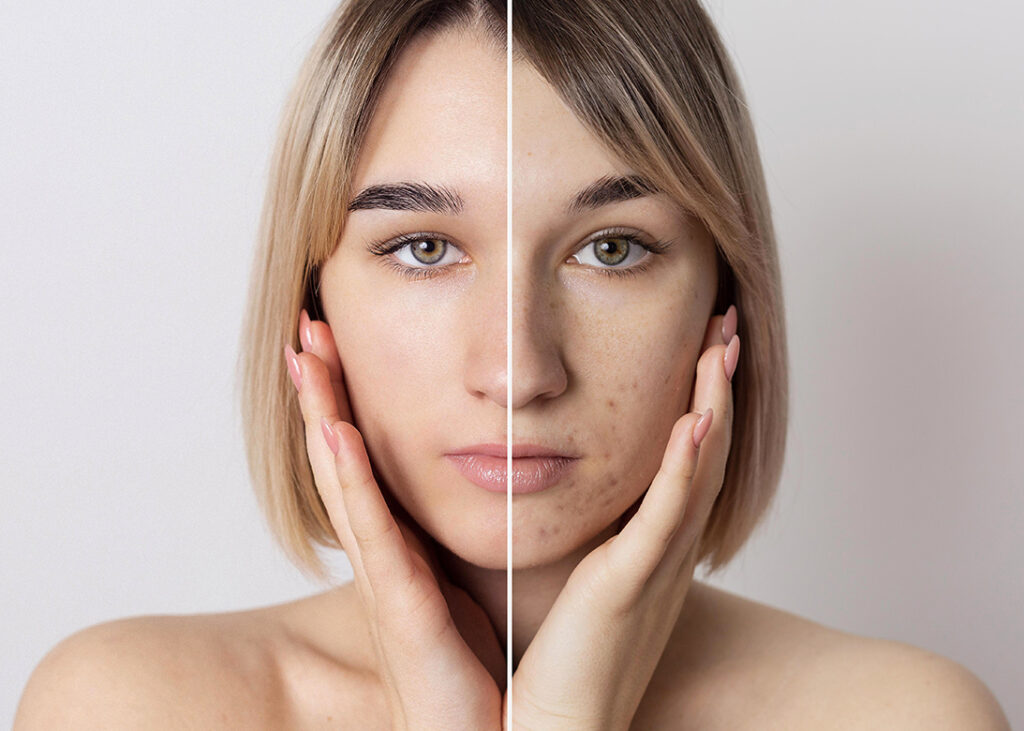 El acné no discrimina por edad, pero nosotros tenemos la solución.