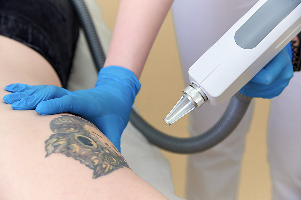 Presenza: Elimina tus tatuajes y recupera tu confianza con tecnología de vanguardia.